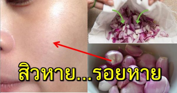 สิ วหา ย รอยก็หา ย ด้วยวัตถุดิบຈากครัว ในราคาหลักสิบ